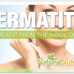Dermatitis